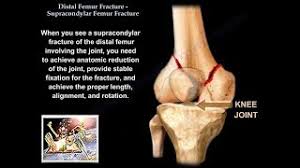 distal fem fracture physiopedia