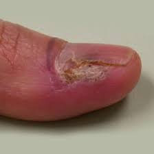 wart removal by dermatologist