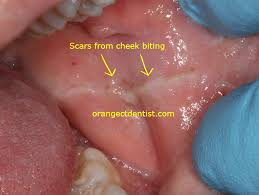 cheek biting calcaterra dentistry