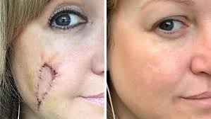 Read on to know more. Indiana Woman Left With Skin Cancer Hole In Face Regrets Better To Be Burnt Than Pale Attitude Fox 46 Charlotte