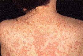 The rash may be localized or generalized. Generalized Granuloma Annulare Treated With Short Term Administration Of Etretinate Journal Of The American Academy Of Dermatology