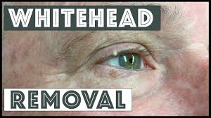 whitehead from the conjunctival rim