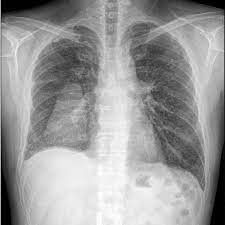 A role in selected clinical circumstances. Chest Radiograph Showing Right Loculated Pleural Effusion Download Scientific Diagram