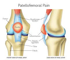 patellofem pain syndrome