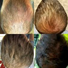 Learn which products actually help prevent hair loss and which ones are just scams! Hair Rejuvenation Exosomes Growth Factors Prp Hair Loss