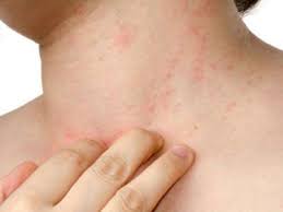 home remes for skin rashes