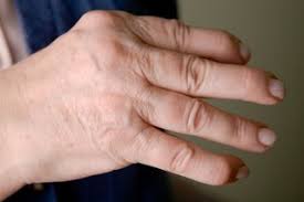 Women are more likely than men to have arthritis in their hands, and often people experience arthritis symptoms in their hands before other signs of arthritis show up. Psoriatic Arthritis Nhs