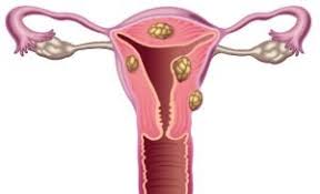 uterine fibroids treatment