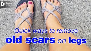 how to remove old scars on legs fast