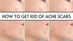 how to get rid of acne scars 5 home
