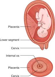 Placenta previa management is a tricky and highly debated topic. Jaypeedigital Ebook Reader