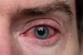 what is blepharitis frantz eyecare