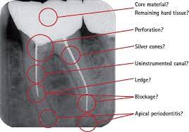 post treatment apical periodonis