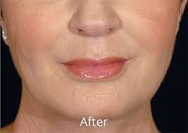 do lip fillers permanently stretch your