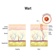 Everything You Need To Know On How Long Do Genital Warts