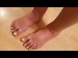 how to relieve swollen feet and ankles