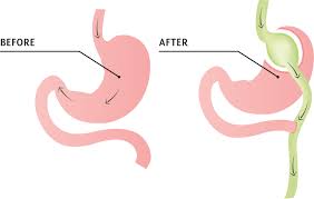 gastric byp surgery