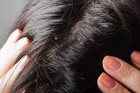 dandruff naturally with home remes
