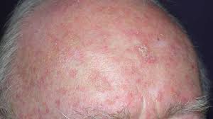 Skin cancer is the most common cancer in the united states and worldwide. Skin Cancer Symptoms Pictures Types And More