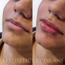 lips aesthetics by dr anj