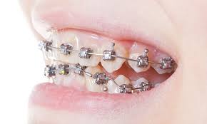 How does invisalign work without braces. What Is An Underbite Westermeier Martin Dental Care