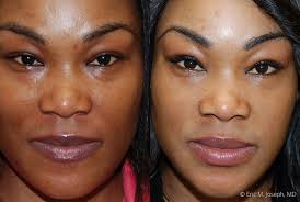 con lower eyelid fat pad removal