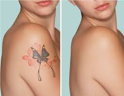 unwanted tattoo removal calgary ab