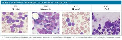 Leukemia Causes Symptoms And Treatments