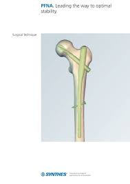 proximal fem nail antirotation pfna