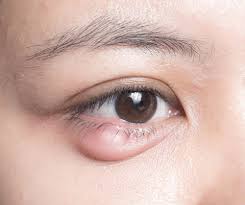 styes floaters dry eye three common