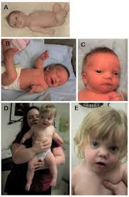 Down syndrome causes changes in physical development. Robinow Syndrome Medlineplus Genetics