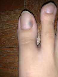 injury or fungal infection
