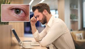 how bloodshot eyes can be a symptom of