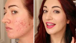 cover acne scarring with bb cream