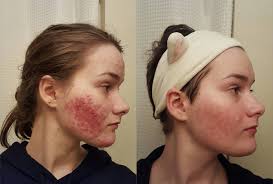 redditors cleared their acne