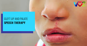 cleft lip and palate sch therapy