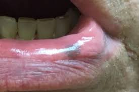 derm dx dark lesion on lower lip