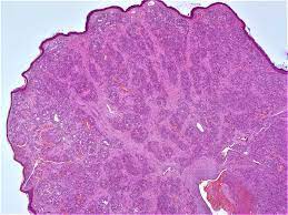 pathology outlines hemangioma variants