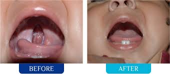 cleft lip palate surgery face