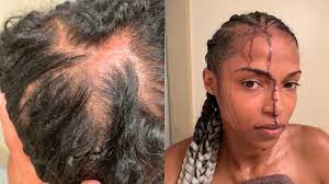 scalp irritation from afreezm braiding