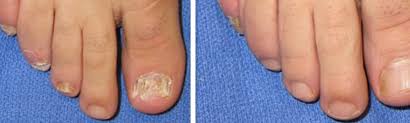 laser toenail fungus removal magic
