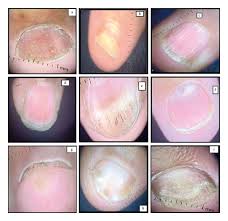 dermoscopic features of psoriatic nails