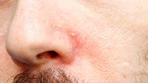 psoriasis in nose symptoms treatments
