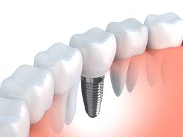 absolute dental implants or