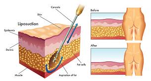 can fat cells grow back after liposuction