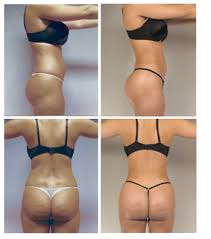 Anesthesia fee, and surgical facility fee. Brazilian Butt Lift Fat Grafting Houston Texas Asps Cosmetic Plastic Surgery