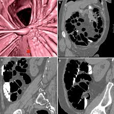 the ileocecal valve springerlink