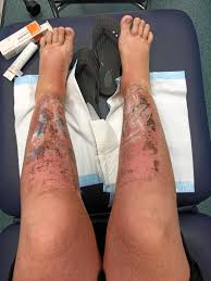 Woman Suffers Third Degree Burns From The Sun Fraser Coast