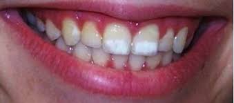 what are white spots on teeth