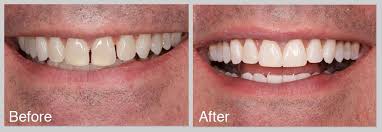 The basic principle is that you slip one teeth gap band * around your tooth gap and sleep the night away. 31 Orthofill Ideas Gap Teeth Teeth Fix Teeth